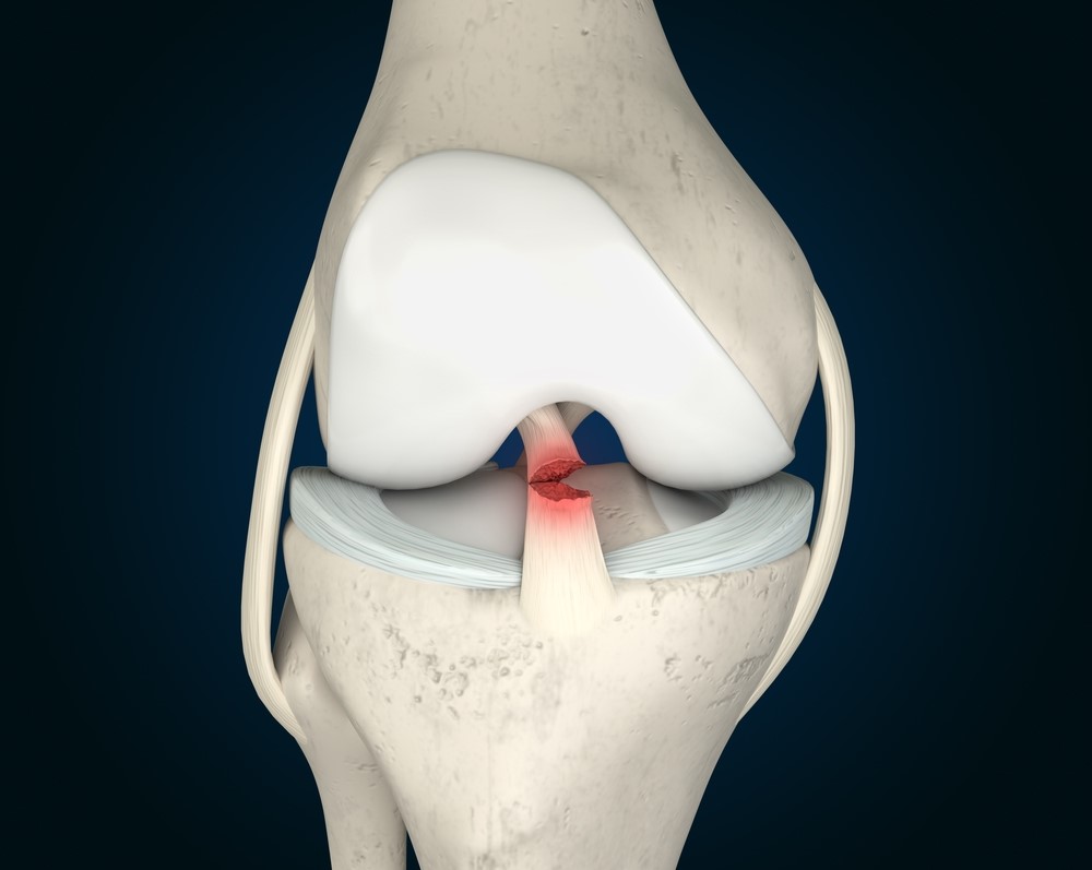 rotura do ligamento cruzado anterior